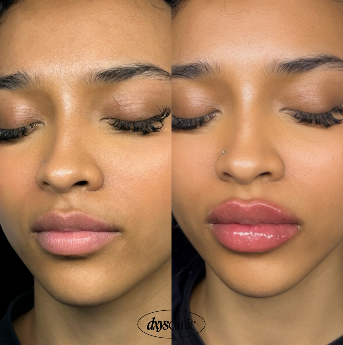 Before and after photo showing natural-looking aesthetic treatment results at Dxy's Clinic, Stoke Newington