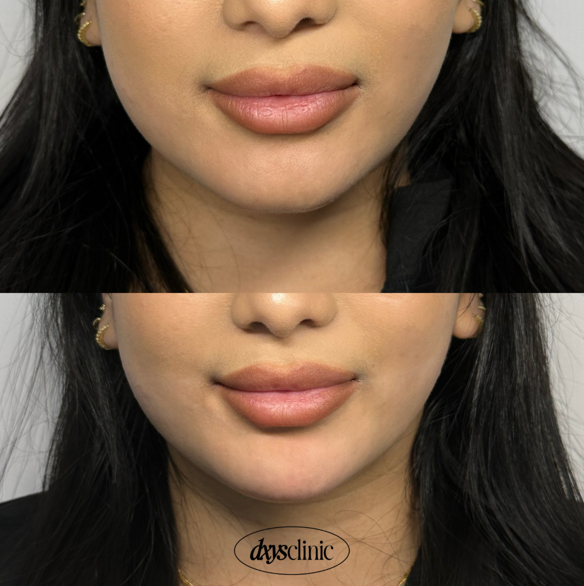 Before and after result two weeks after dermal filler treatment at Dxy's Clinic, Stoke Newington