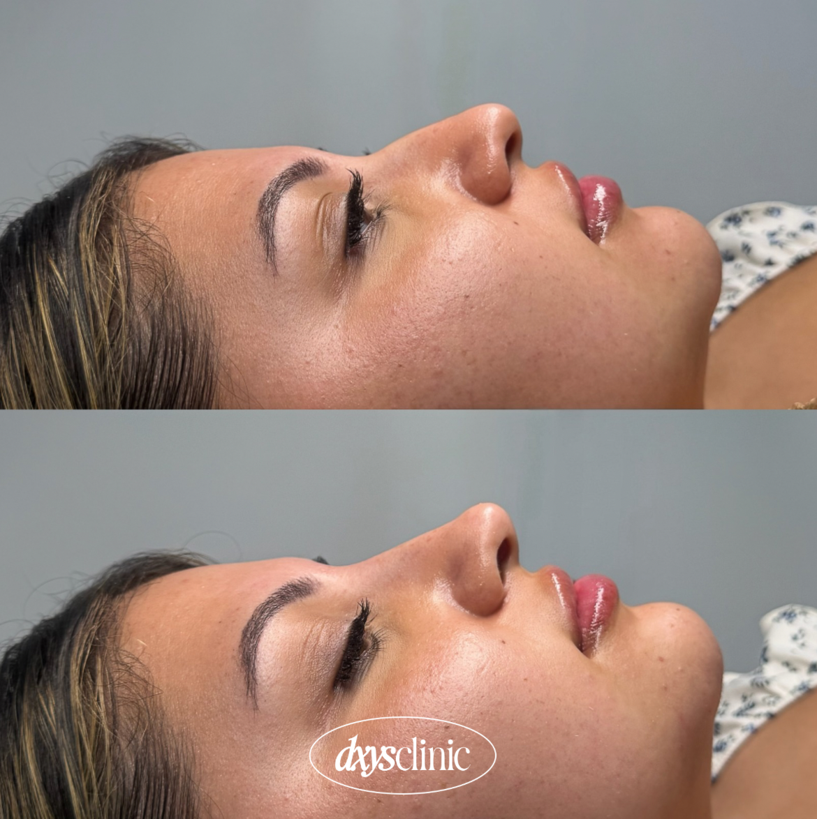 Before and after result from an aesthetic treatment at Dxy's Clinic, Stoke Newington, showing a natural, refined outcome