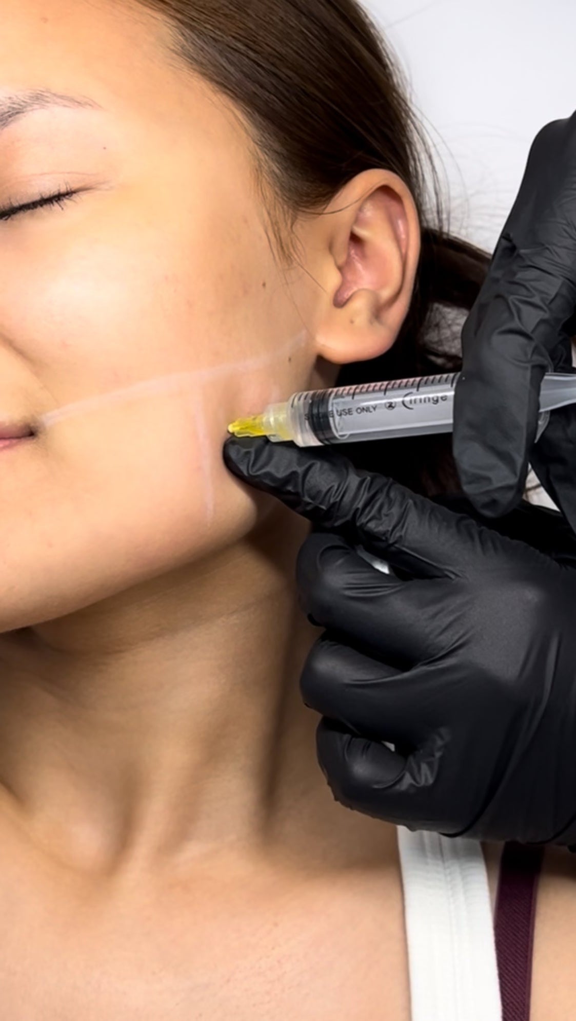 Before and after result from anti-wrinkle injection treatment at Dxy's Clinic, Stoke Newington
